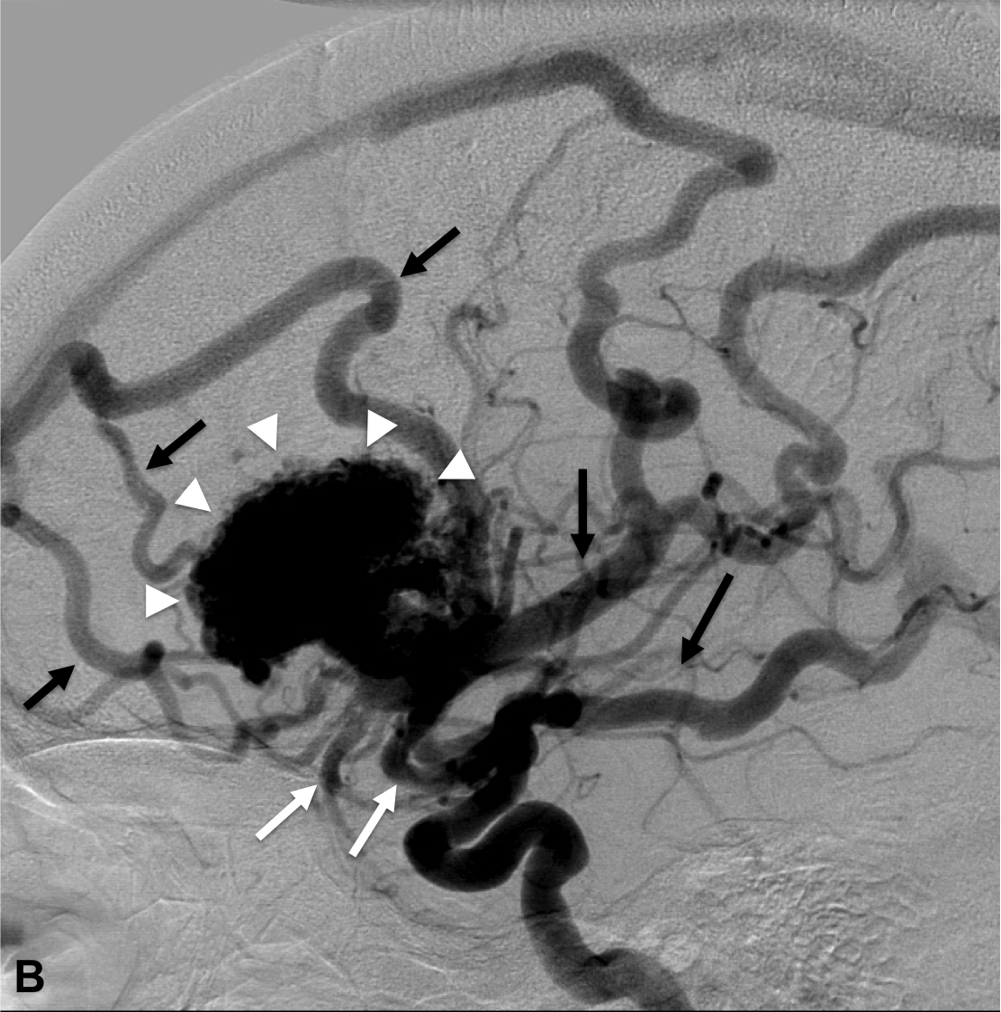 Malformation Arterio Veineuse Malformations Art rio veineuses IXDVUA