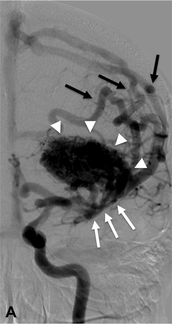 Malformations Art rio veineuses Hopital Piti Salp tri re