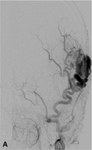 Fistule superf