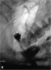 Stent.2 - copie