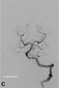 Thrombectomie.2