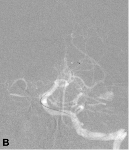 Thrombectomie.3